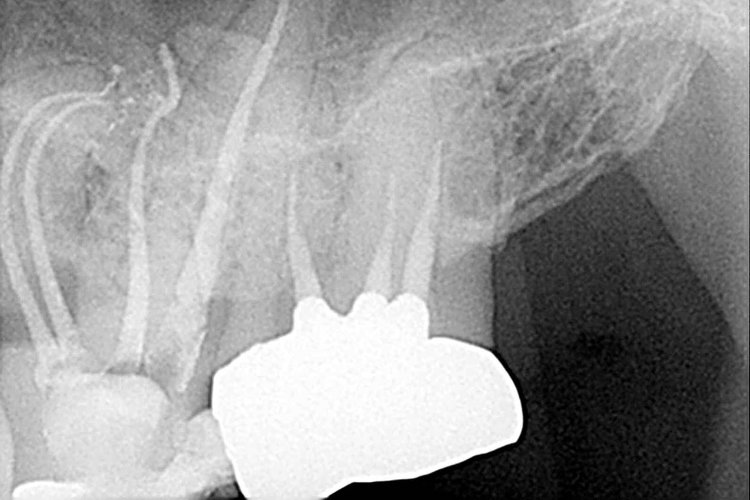 CASE STUDY: Coronal minimally invasive access