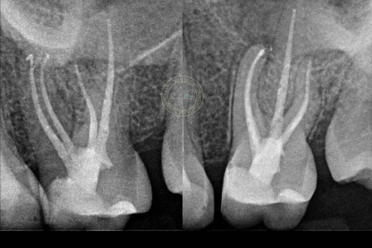 CASE STUDY: A challenging second molar with 4 canals