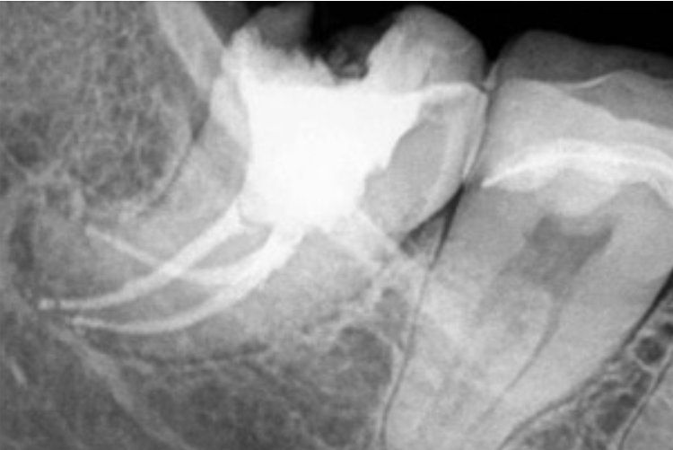 CASE STUDY: Minimal invasive coronal access